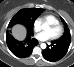 Pulmonary Embolism - CTisus CT Scan