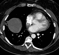 Pulmonary Embolism - CTisus CT Scan