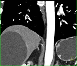 Pulmonary Embolism - CTisus CT Scan