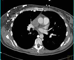 SVC Occlusion With Collaterals. Tumor Extends Into the Right Atrium - CTisus CT Scan