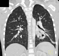 Sequestration - CTisus CT Scan