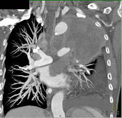 Lung Cancer Invades the Left Atrium - CTisus CT Scan