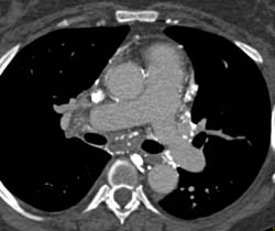 Collaterals Around the Pericardium - CTisus CT Scan