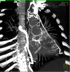 SVC Occlusion With Collaterals Around the Heart - CTisus CT Scan