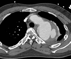 Aortic Dissection and Ulceration With Intramural Hematoma - CTisus CT Scan