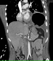 Tear in Diaphragm With Herniation of Stomach and Gastric Ischemia - CTisus CT Scan