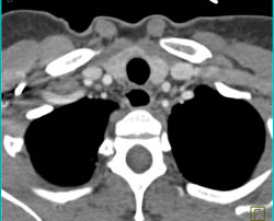 Esophageal Cancer With Obstruction - CTisus CT Scan