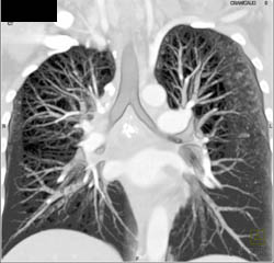 Virtual Bronchoscopy With Narrow Left Mainstem Bronchus - CTisus CT Scan