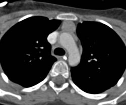 Thymoma - CTisus CT Scan