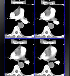 Timing of Contrast to Pulmonary Artery and Aorta - CTisus CT Scan