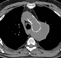 Endostent Repair of Thoracic Aortic Aneurysm - CTisus CT Scan