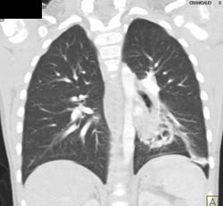 Sequestration - CTisus CT Scan