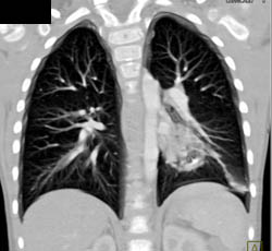 Sequestration - CTisus CT Scan