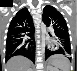 Sequestration - CTisus CT Scan