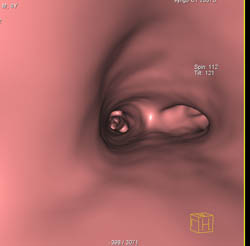 Sequestration - CTisus CT Scan