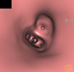 Sequestration - CTisus CT Scan