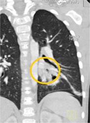 Sequestration - CTisus CT Scan