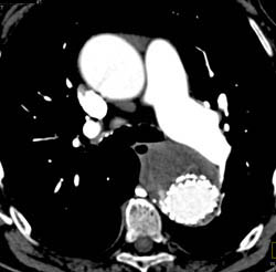 Stent Repair - CTisus CT Scan