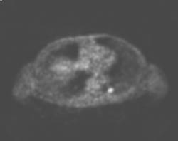 Metastatic Thyroid Cancer in Left Lower Lobe - CTisus CT Scan