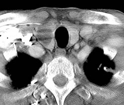 Anaplastic Thyroid Cancer - CTisus CT Scan