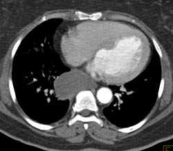 Bronchogenic Cyst - CTisus CT Scan