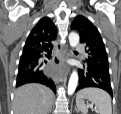 Bronchogenic Cyst - CTisus CT Scan