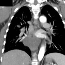 Bronchogenic Cyst - CTisus CT Scan