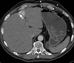 Hot Spot Liver Due to SVC Occlusion and Collateral Flow - CTisus CT Scan