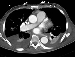 Pe - CTisus CT Scan