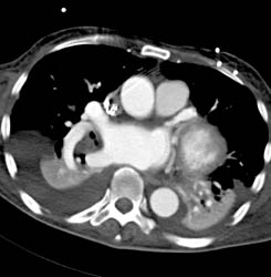 Pe - CTisus CT Scan