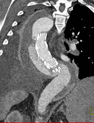 Stent to Repair Type A Dissection - CTisus CT Scan