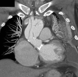 Type A Dissection With Stent Repair - CTisus CT Scan