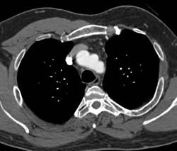 Absent Left Pectoralis Muscle - CTisus CT Scan