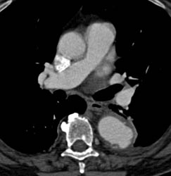 Aortic Ulceration - CTisus CT Scan