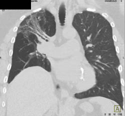 Bronchiectasis With Inflammation Right Upper Lobe - CTisus CT Scan