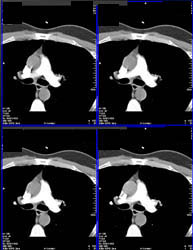 Timing of Pulmonary Embolism (PE) Injection - CTisus CT Scan