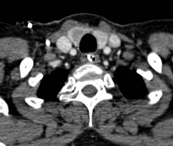 Thyroid Nodule - CTisus CT Scan