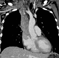 Tumor Extends From SVC Into Right Atrium - CTisus CT Scan