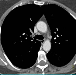 Pe - CTisus CT Scan