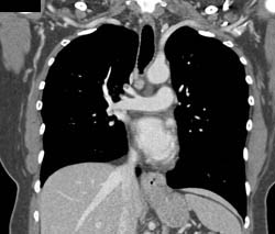 Pe - CTisus CT Scan