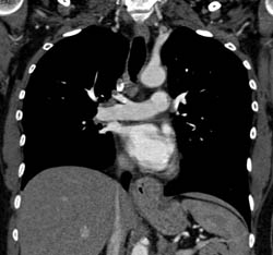 Pe - CTisus CT Scan