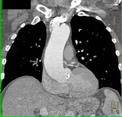 Aortic Valve Calcifications With Dilated Ascending Aorta and Abnormal Aortic Valve - CTisus CT Scan