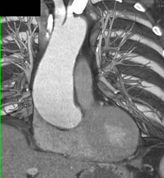 Aortic Stenosis With Dilated Ascending Aorta - CTisus CT Scan