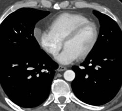 Pericardial Cyst - CTisus CT Scan