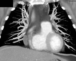 Pericardial Cyst - CTisus CT Scan