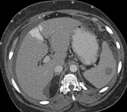 SVC Syndrome With Hot Spot Liver and Extensive Collaterals - CTisus CT Scan