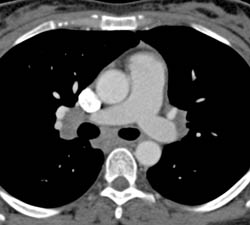 Lymphoma With Nodes and Tumor in Liver and Spleen - CTisus CT Scan