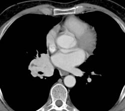 Paraganglioma Right Hilum With Large Bronchial Arteries- See Full Sequence - CTisus CT Scan