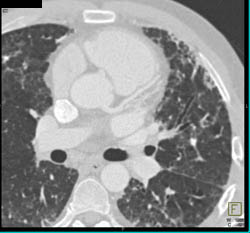 Interstitial Fibrosis- Uip - CTisus CT Scan