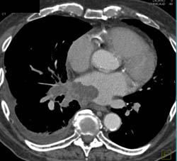 Lung Cancer Invades the Left Atrium and Pulmonary Vein - CTisus CT Scan